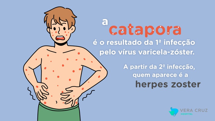 Blog Hospital Vera Cruz - Interno - Catapora e Herpes Zoster