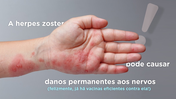 Blog Hospital Vera Cruz - Interno - Herpes Zoster e danos aos nervos