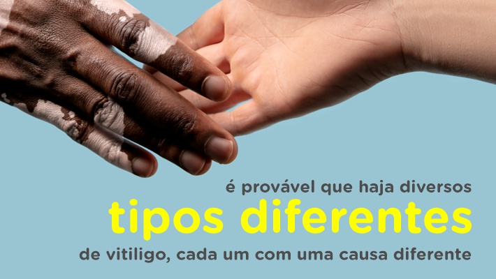 Blog Hospital Vera Cruz - Interno - Dia Internacional do Vitiligo - Tipos diferentes
